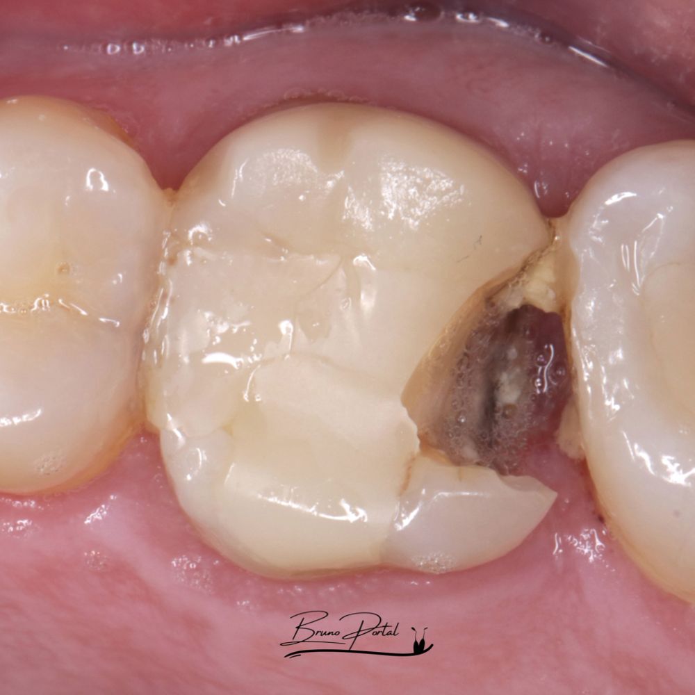 Dente posterior antes, fraturado